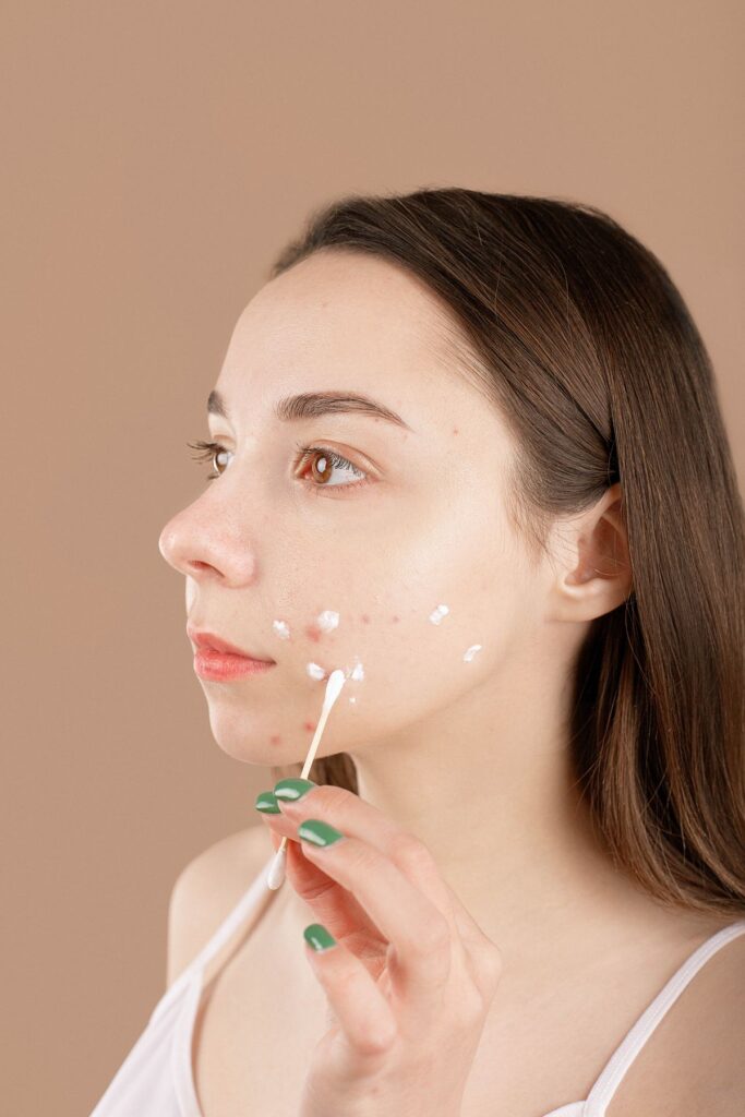 Mujer aplicando crema tratamiento para el acné