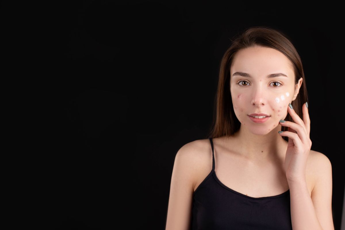 Adolescente con acné aplicando crema